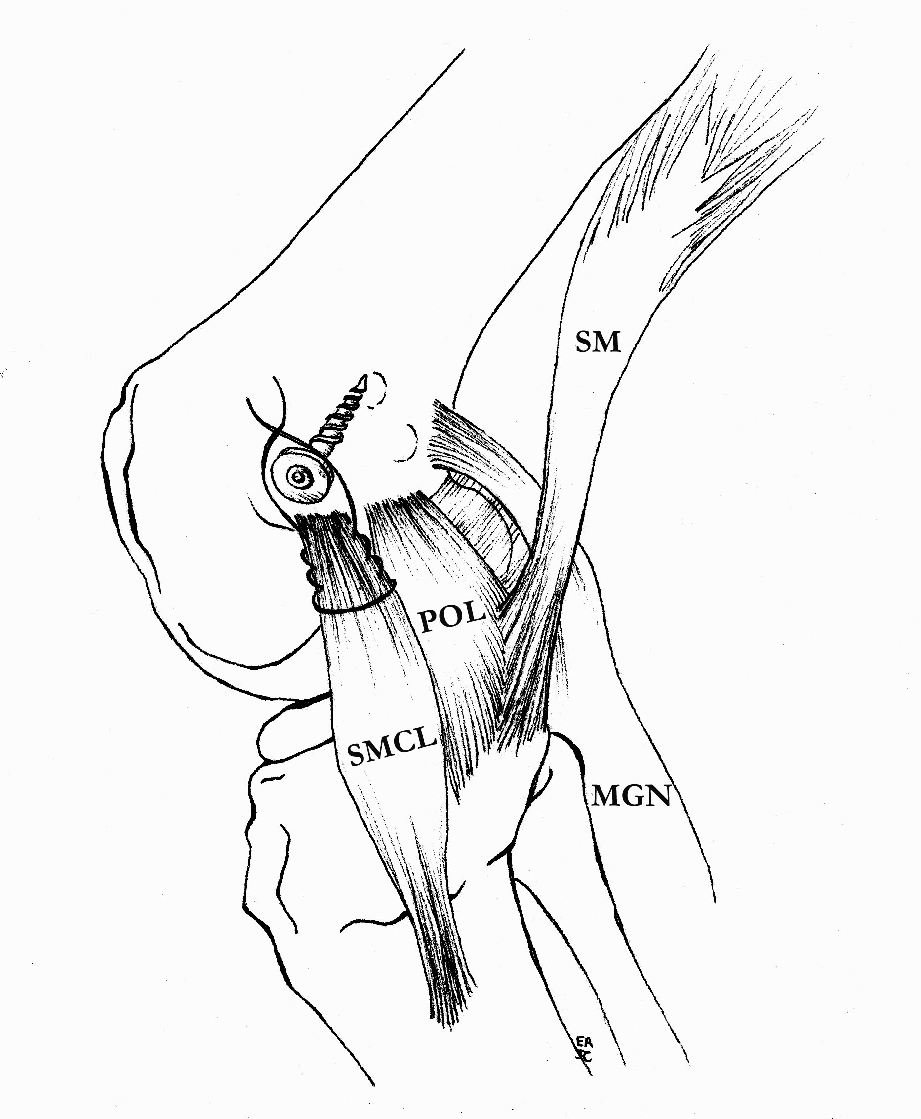 MCL femoral fix 1